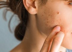 4 Common Misconceptions About Acne To Know