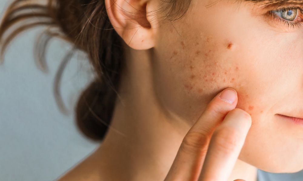 4 Common Misconceptions About Acne To Know